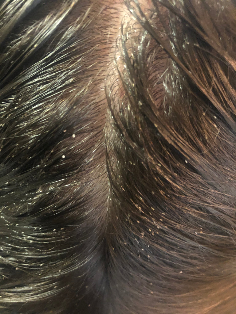 Image of a young lady who have a 3 month lice infestation. This person has hundreds of nits (lice eggs).
